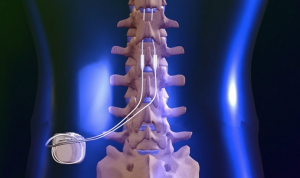 Spinal Cord Stimulation Trial