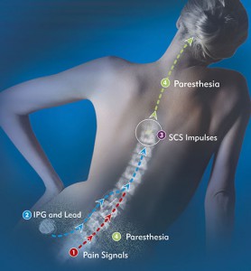 Spinal cord stimulation doesn't help with back pain, says new